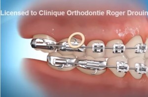 orthodontie et élastiques pour corriger une malocclusion cl.III
