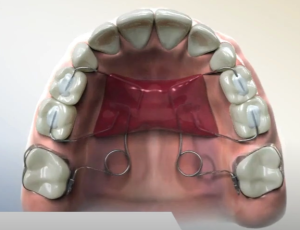 Pendulum : Appareil orthodontique fixe pour reculer les molaires supérieures.