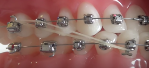 Les élastiques de Classe II en technique orthodontique